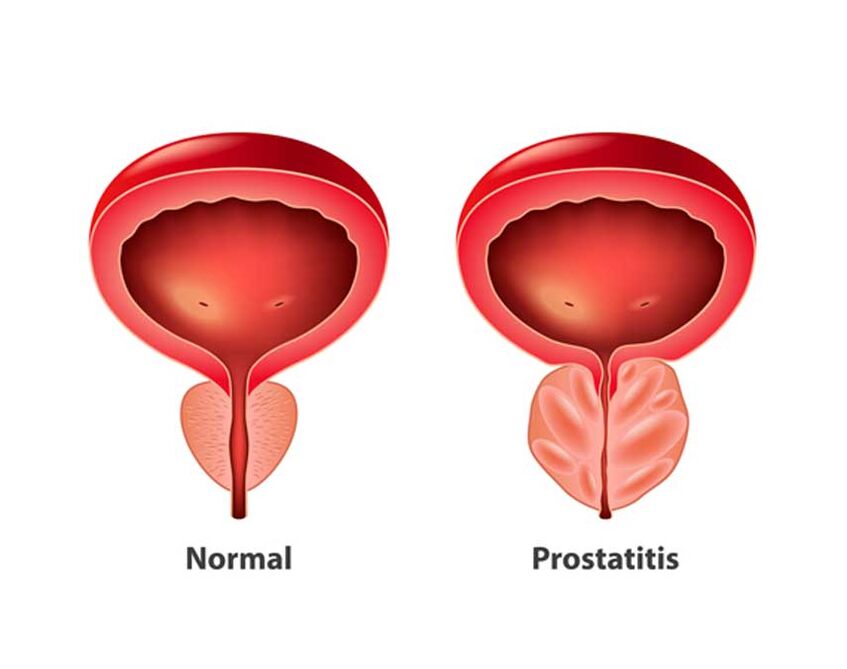 normal and inflammatory prostate