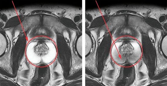 Normal prostate (left) and inflammation of the prostate with prostatitis (right)